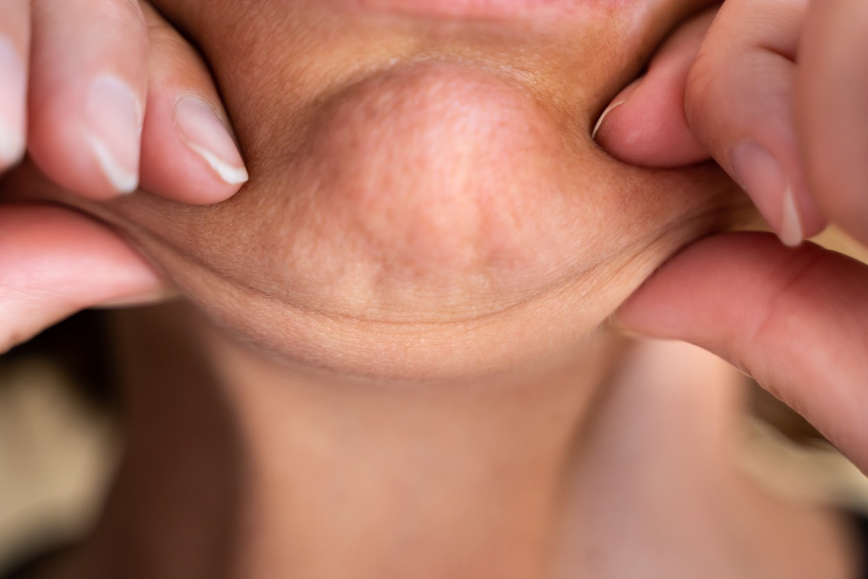 Causes of Goiter in Women: Water Retention, Food Intolerances, and Menstruation