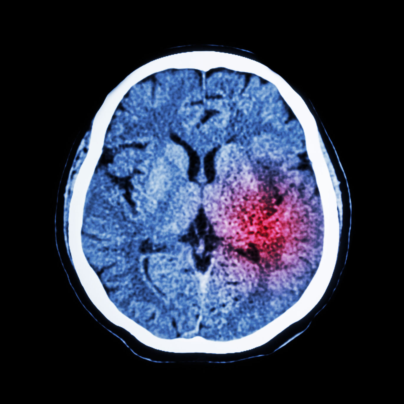 A new drug will help recover patients who have suffered a stroke